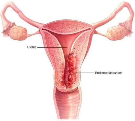 Symptoms of Endometrial Cancer | Treatment Possible