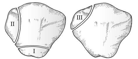 Bipartite Patella | Bone and Spine