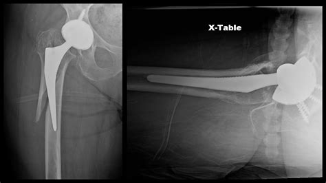 Periprosthetic Femur Fracture ORIF, Stem Revision