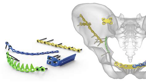 Pelvic Plating System | Acumed