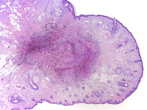 Dermatofibroma Histology