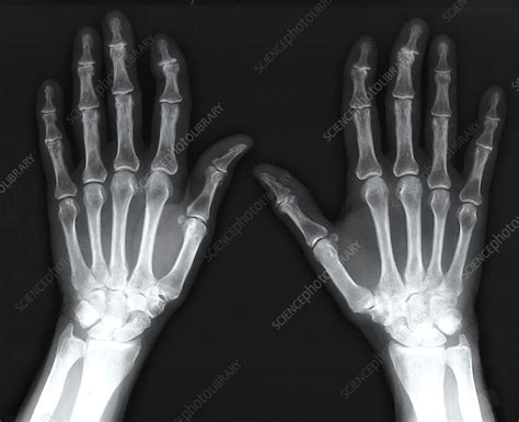 Osteoarthritis, X-ray - Stock Image - C055/1141 - Science Photo Library