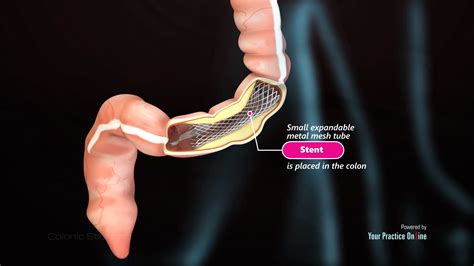 Colonic Stenting Video | Medical Video Library