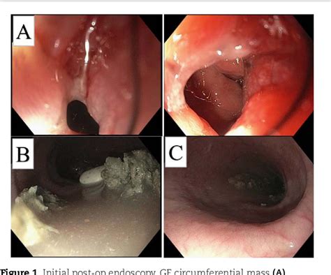 Figure 1 from Gastroesophageal junction adenocarcinoma 1-year after ...