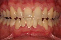 Periodontal Disease - Bleeding Gums - Gum Disease