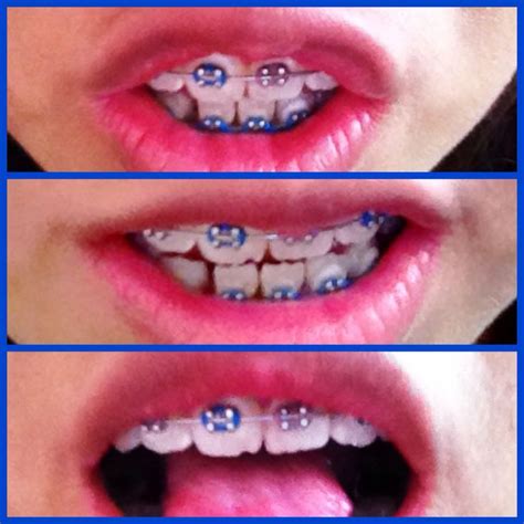 Brackets Ligas de color azul y morado Dientes,braces,orthodontics,lips ...