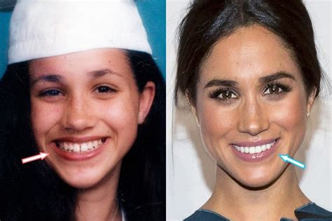 Meghan before and after new teeth veneers. | Beautiful teeth, Veneers ...