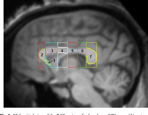 Figure 1 from Planum temporale asymmetries correlate with corpus callosum axon fiber density in ...