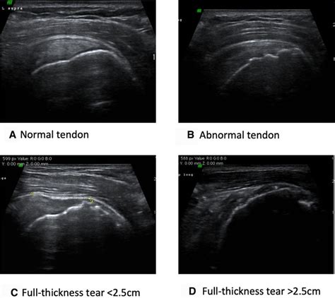 Tendon classification on ultrasound. (A) Normal tendon: normal... | Download Scientific Diagram