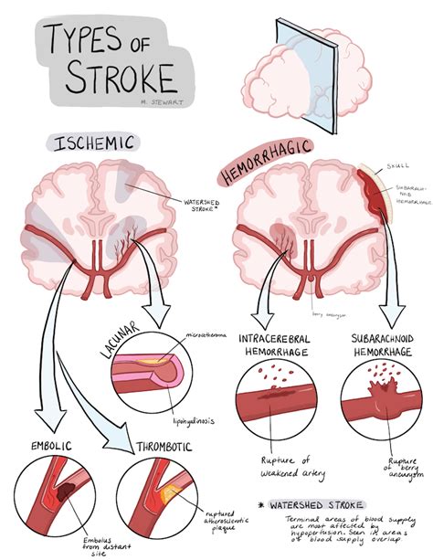 Need a review of the different types of stroke? Stroke can be divided ...