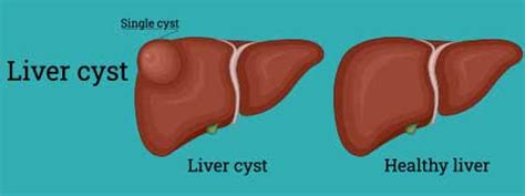 Liver Cyst: Causes, Symptoms And Treatment