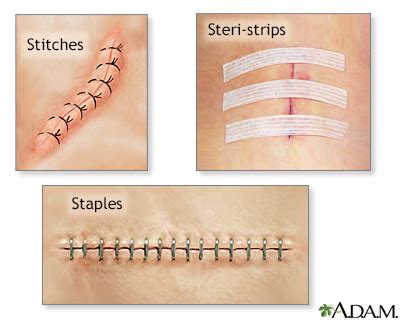 Laceration - sutures or staples - at home Information | Mount Sinai ...