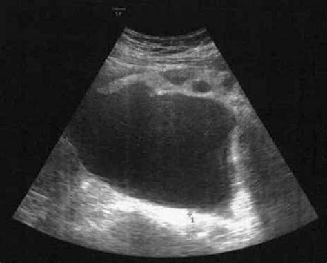 Presence of an adnexal mass at the ultrasound. | Download Scientific ...