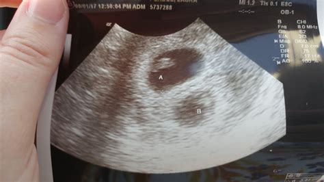 7 week ultrasound - twins : r/CautiousBB