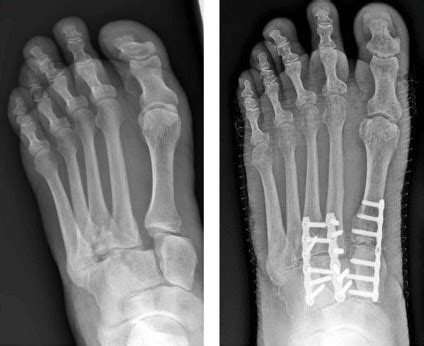 Lisfranc injury