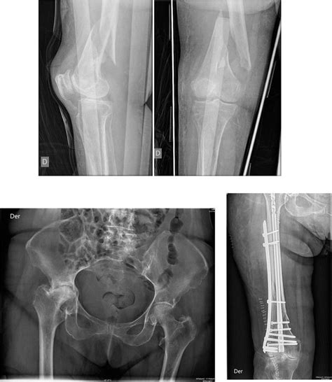 Management of Distal Femoral Fractures | IntechOpen