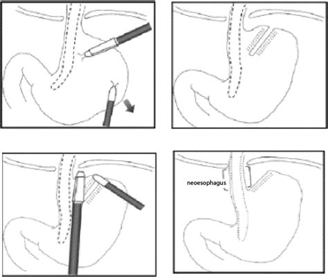 Collis Gastroplasty