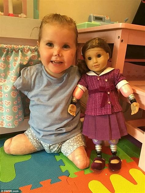 Toddler who lost all her limbs to meningitis is given a doll with ...