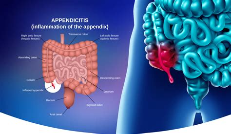 Best Appendicitis Treatment in Delhi | Appendicitis Surgery in Delhi