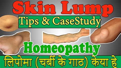 Lipoma Symptoms and Causes - Fatty Tumor | Fatty Lump Under skin Causes - What Is Lipoma - YouTube