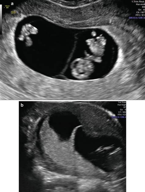 First-Trimester Ultrasound: Guidelines | Radiology Key