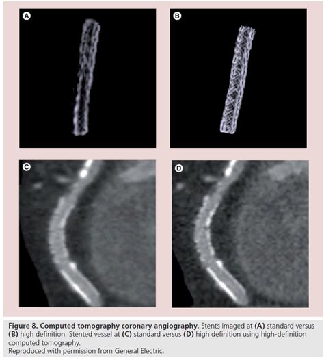 driver coronary stent mri safety guidelines - efiraceof