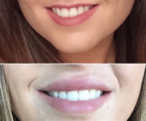 #LipFillers | Lip fillers, Lip injections, Perfect lips