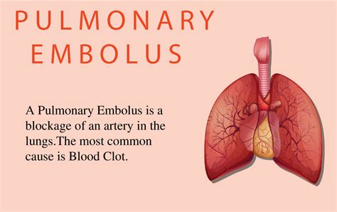 Pulmonary Embolism Explained: Causes, Symptoms, and Treatment