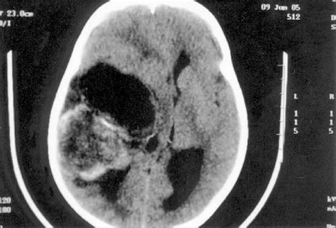 Computed tomography displaying a bulk tumor in right temporal lobe,... | Download Scientific Diagram