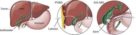 How Do You Treat A Gallbladder Drain - Best Drain Photos Primagem.Org