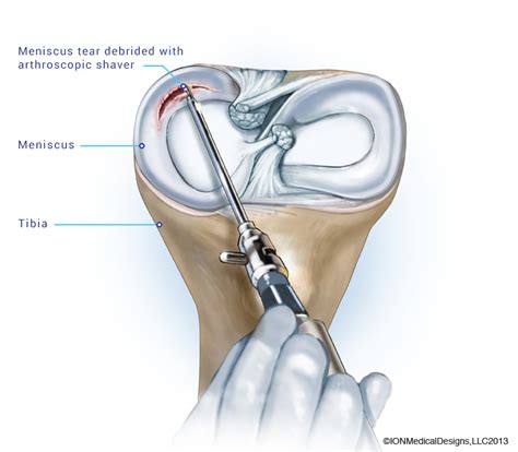 Meniscus Repair - Joint Preservation Center