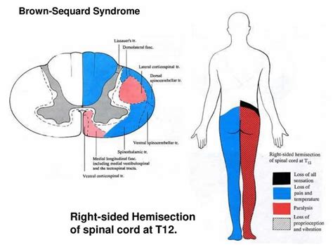 Brown Sequard syndrome causes, symptoms, diagnosis, treatment & prognosis