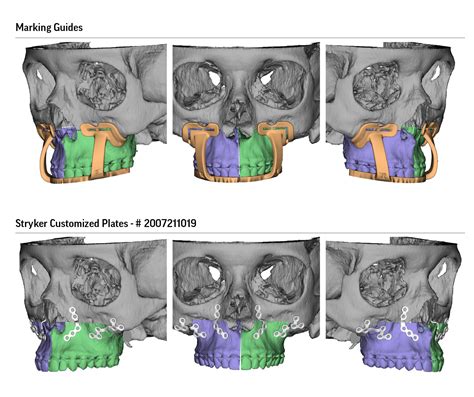 Surgical Planning for Maxillofacial Surgery - Airway & Sleep Group