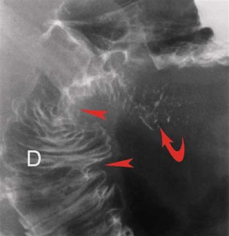 Stomach and Duodenum | Radiology Key