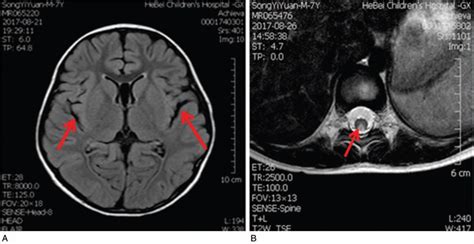 Isolated subacute combined degeneration in late-onset cobala... : Medicine