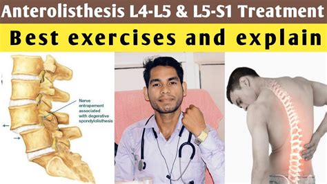 anterolisthesis l5 s1 treatment, anterolisthesis grade 1 treatment exercises, l4 l5 lumbar spine ...