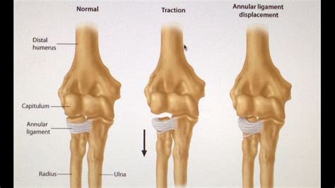 Image result for annular ligament of radius | Elbow, Gorna, Subluxation