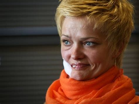 Surgery rebuilds woman's disfigured face