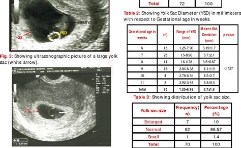 Table 2 from Size of Yolk Sac by Ultrasonography and Its Correlation with Pregnancy Outcome ...