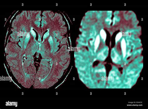 CREUTZFELDT JAKOB DISEASE, MRI Stock Photo - Alamy