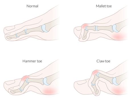 What is Hammer Toe? Symptoms, Causes, Diagnosis & Physiotherapy, hammer ...