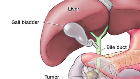 What is the Whipple Procedure - Mayo Clinic - Medical Discover