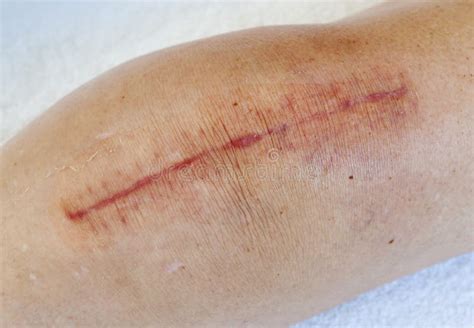 Scar from knee surgery stock photo. Image of incision - 14577554