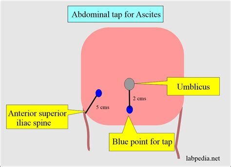 Fluid Analysis Part Ascitic Fluid Peritoneal Tap Abdominal | My XXX Hot Girl