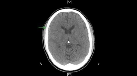 Cureus | A Sub-acute Cerebral Contusion Presenting with Medication-resistant Psychosis