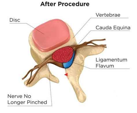 Laminectomy | BioSpine Institute