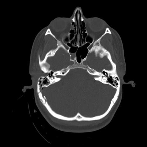 Post Gad: Trauma - Petrous Bone Fracture