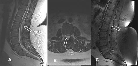 Cureus | Lumbar Extradural Angiolipoma: Clinical Presentation and ...