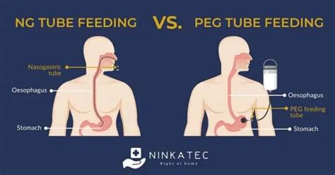 Enteral Nutrition And Care Of Nasogastric Tube (NG Tube) In Home Care Patients | Ninkatec