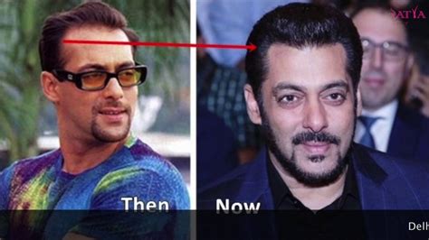 Salman Khan Hair Transplant Place / Since salmans hair transplant in ...